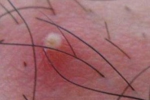 不同部位的毛囊炎要怎么护理